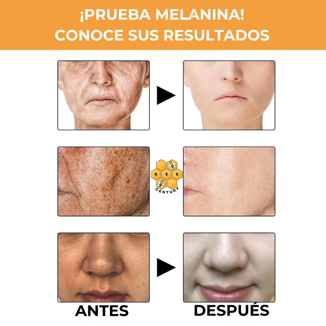 MELANINA FACIAL™ - QUITA MANCHAS